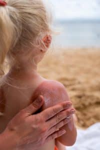 כוויות שמש טיפול