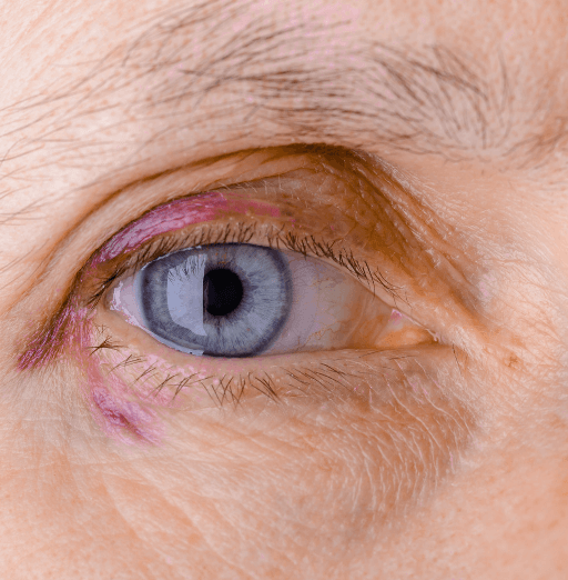 פגיעות עיניים