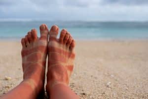 כוויות שמש ברגליים