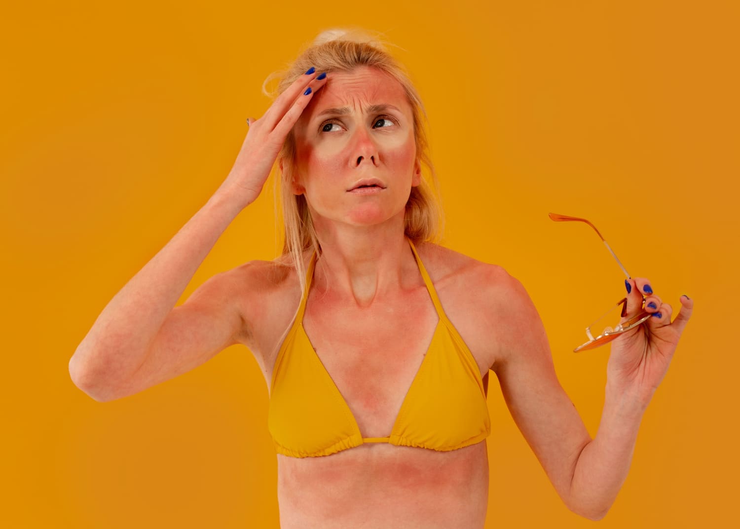 הישרפות מהשמש