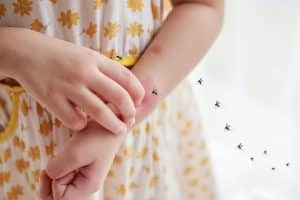 עקיצות יתוש מתנפחות