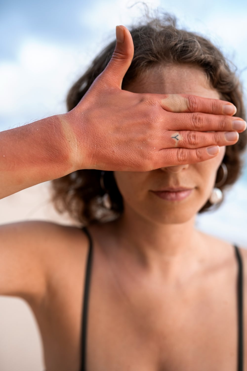 כוויות שמש חמורות